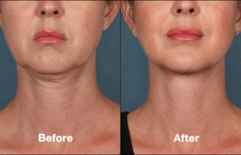 Wrinkle Relaxing Injectables: Botox & Nuceiva